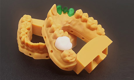 Wide application of R3pro dental 3D printer in the field of temporary crowns